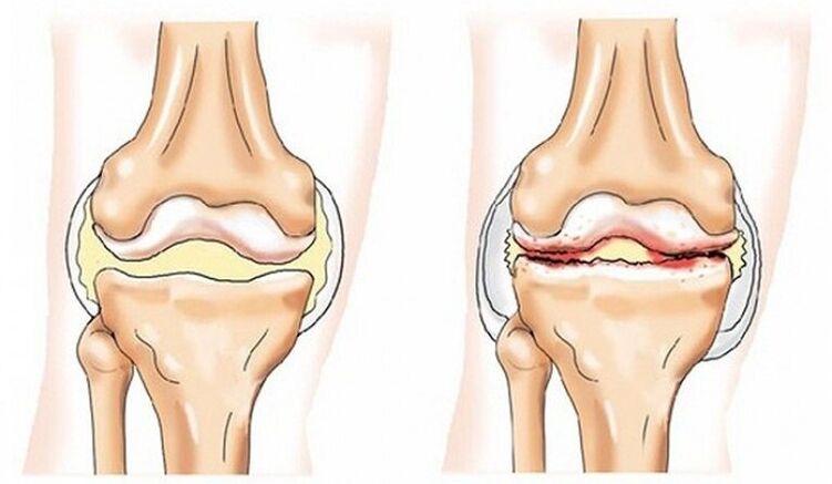 Gesunde Artikulation und Artikulation, die durch Arthrose betroffen ist