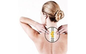 zervikale Osteochondrose bei einer Frau