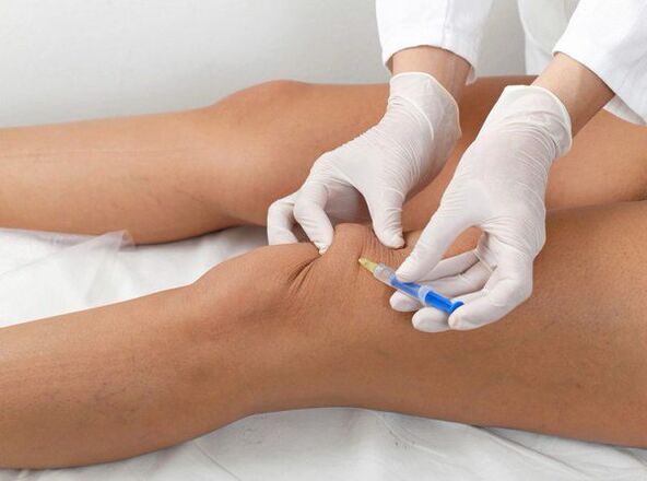 Intraartikuläre Injektion bei Knie-Arthrose.