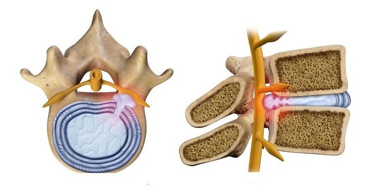 Bandscheibenvorfall Vorwölbung des Bandscheibenkerns in den Wirbelkanal